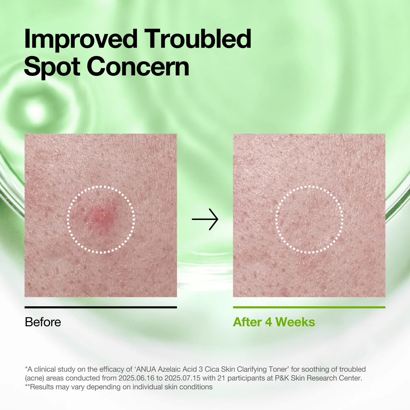 Тонер с азелаиновой кислотой Anua Azelaic 3 Cica Skin Clarifying Toner 250ml