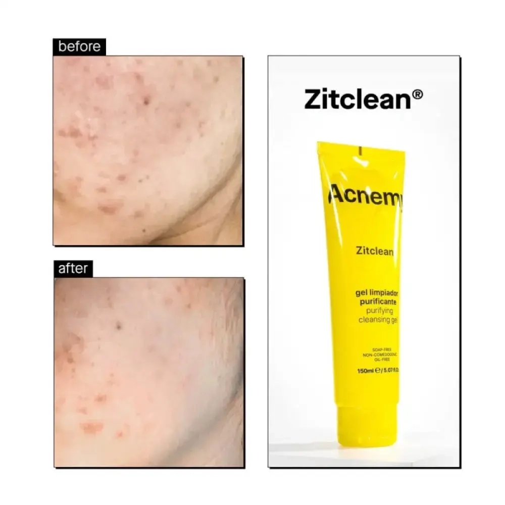 Гель очищающий Acnemy Zitclean с азелаиновой и салициловой кислотой 150ml